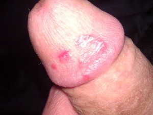 Eczema on penis head 640X480 jpeg
