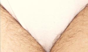 Bikini laser photo pubic hair removal 960X579 jpeg
