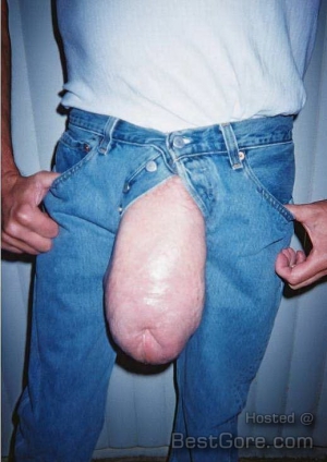 Silicone injections into penis 519X735 jpeg