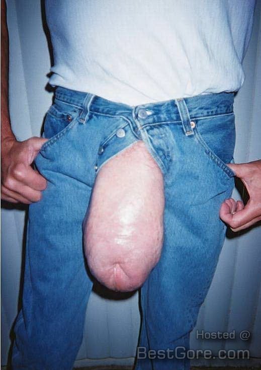 Silicone injections into penis full size