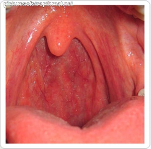 Strep throat rash 600X593 jpeg