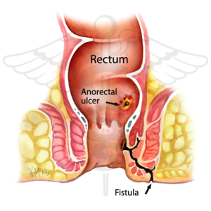 Seton anal fistula 425X425 jpeg