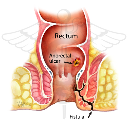Seton anal fistula full size