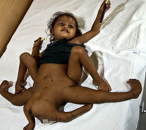 Baby born with 8 limbs full size