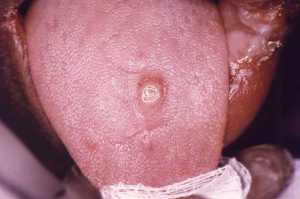 The primary stage syphilis chancre sore on tongue 960X639 jpeg