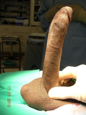 Penis after penile implant 960X1282 jpeg