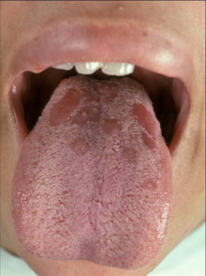 Syphilis on tongue 960X1286 jpeg