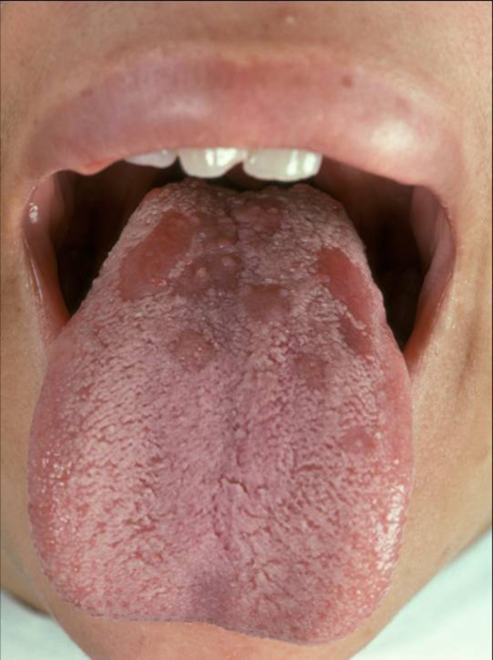 Syphilis on tongue full size