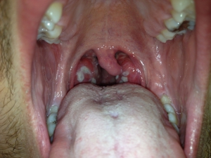 Strep throat 960X720 jpeg
