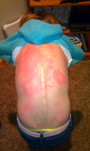 Latex allergy reaction rash 958X1600 jpeg
