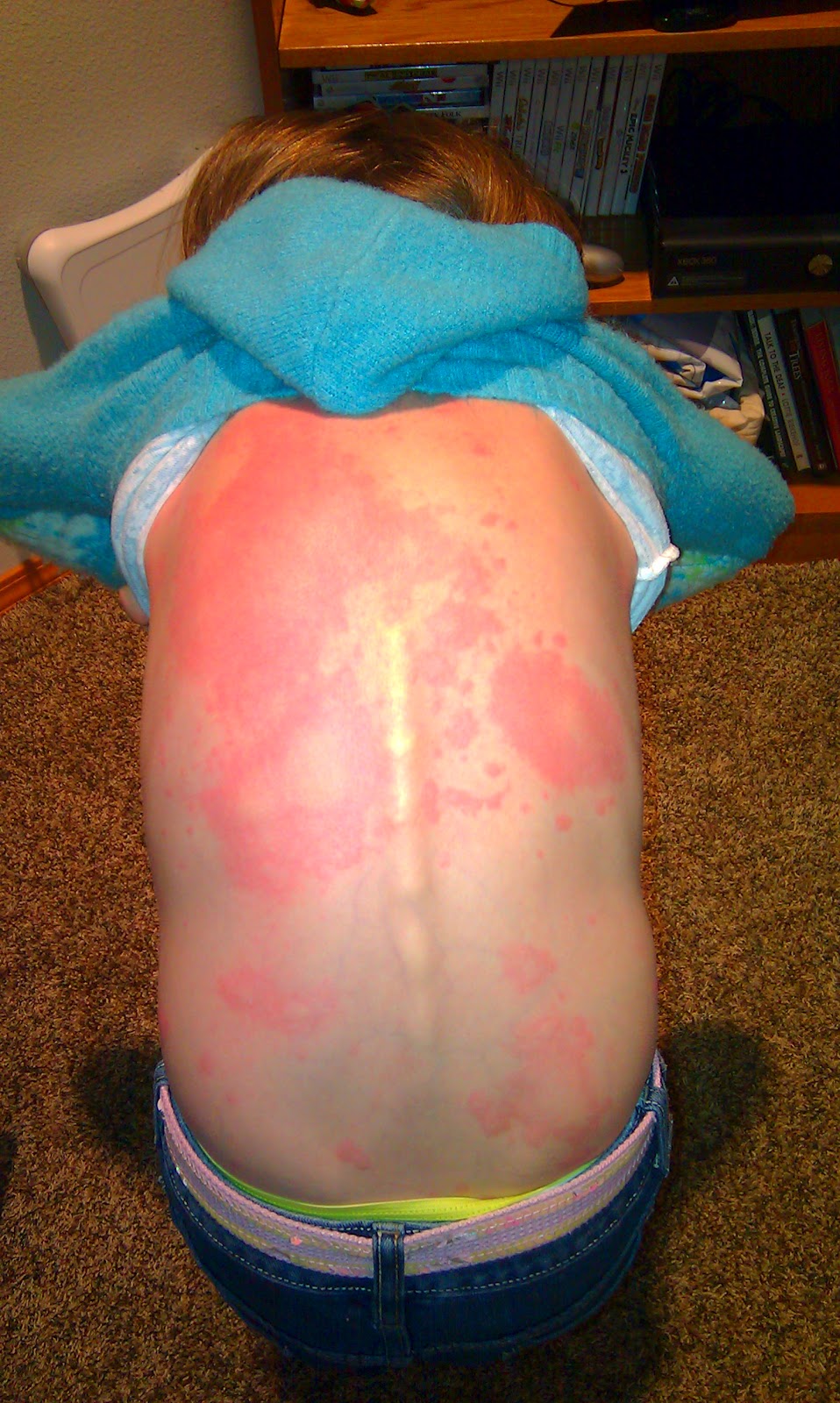 Latex allergy reaction rash full size