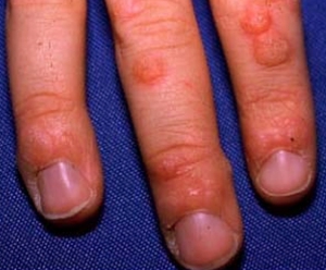 Warts on hands 706X584 jpeg