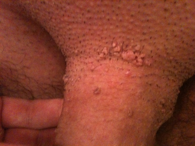 Bumps on pubic area men full size