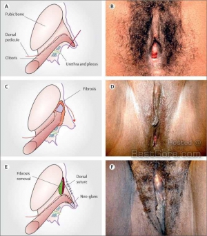 Female genital mutilation 670X765 jpeg