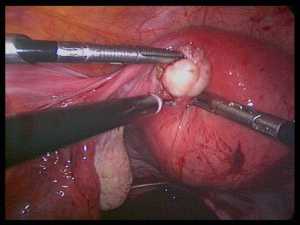 Vagina bleeding during period 768X576 jpeg