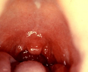 Strep throat bacteria 718X585 jpeg