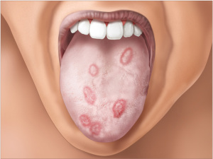 Early stage syphilis symptoms mouth 960X722 jpeg