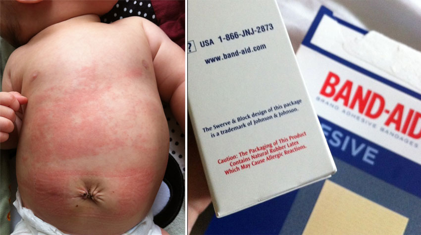 Latex allergic reaction rash full size