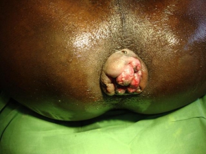 Bleeding hemorrhoids with anal sex 900X675 jpeg