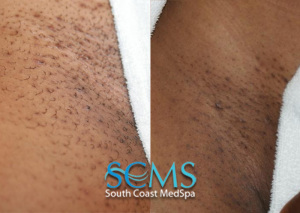 Laser hair removal bikini line 700X498 jpeg