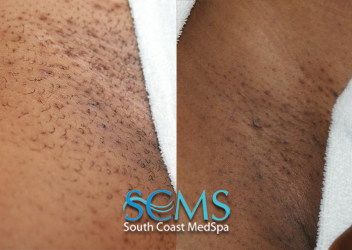 Laser hair removal bikini line full size