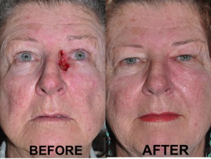 Facial reconstruction before and after surgery 720X546 jpeg