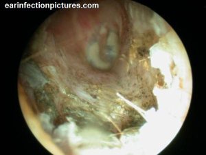 Fungus ear infection 600X450 jpeg
