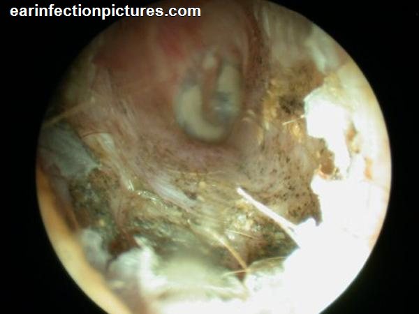 Fungus ear infection full size