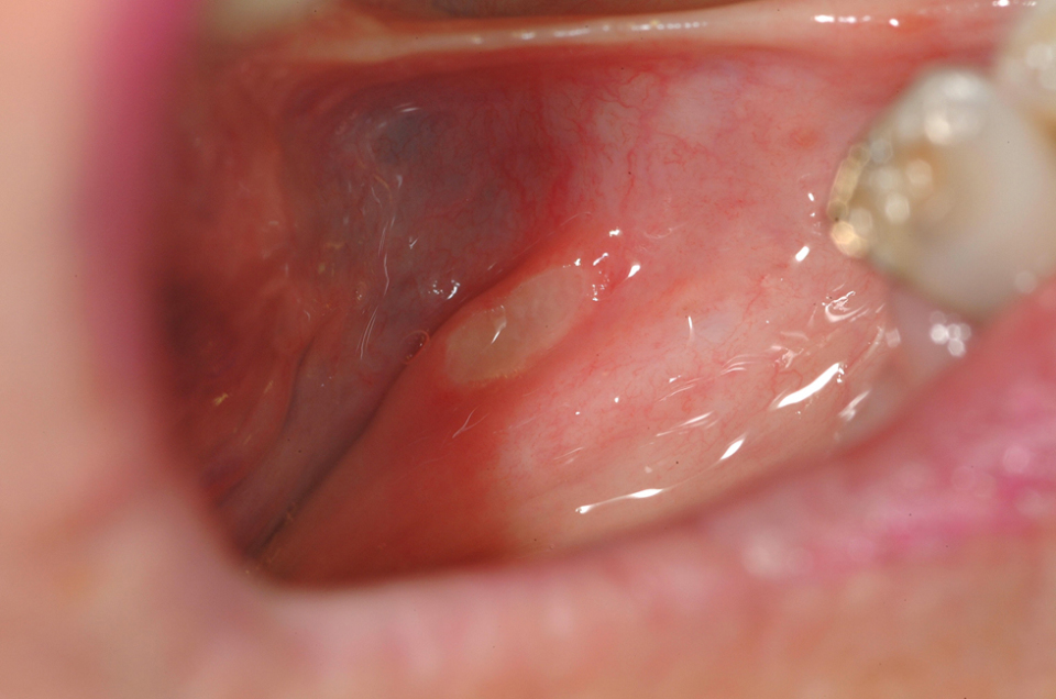 Ulcer on floor of mouth full size
