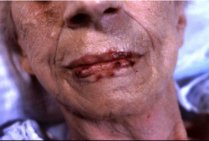 Herpes simplex on penis 645X438 jpeg