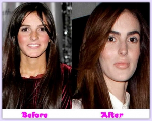 Ali lohan before and after plastic surgery 549X437 jpeg
