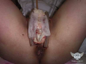 Sex change penis to vagina 582X437 jpeg