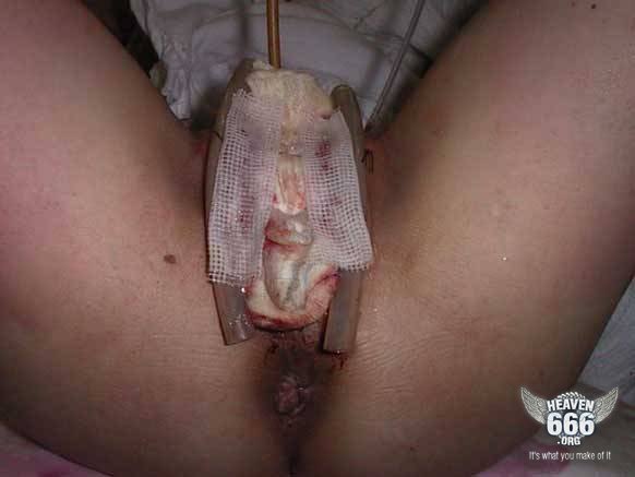 Sex change penis to vagina full size