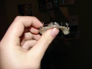 How to fix an overbite with braces 640X480 jpeg