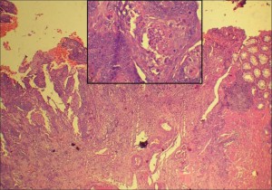 Anal squamous cell carcinoma 836X586 jpeg