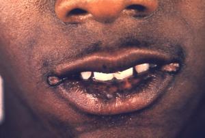 Syphilis mouth sores 700X472 jpeg
