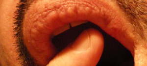 Genital herpes early stage lip 960X436 jpeg