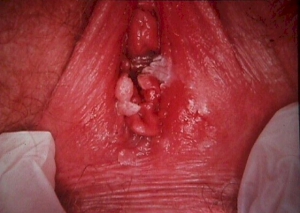 Genital warts inside vagina opening 639X455 jpeg