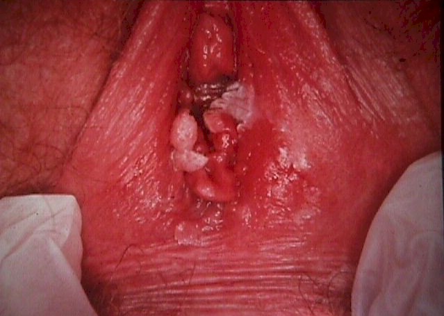 Genital warts inside vagina opening full size