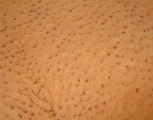 Laser hair removal bikini area 610X480 jpeg
