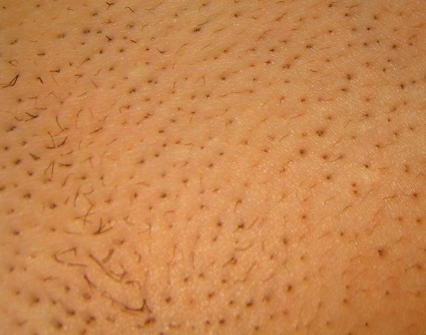 Laser hair removal bikini area full size