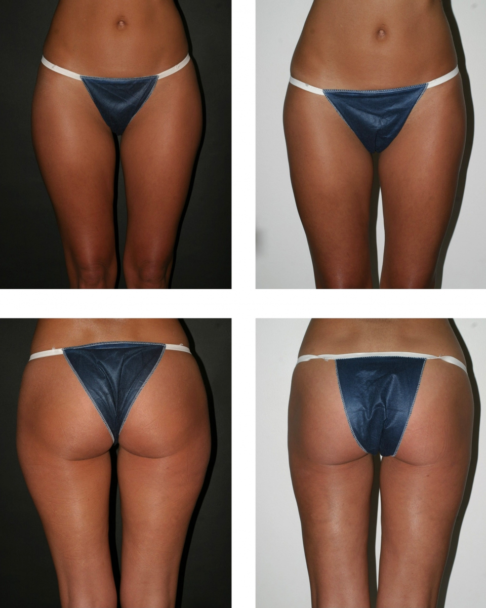 Liposuction without surgery full size
