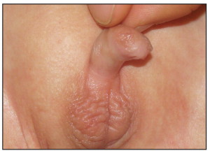 Micro penis 960X701 jpeg