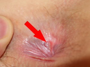 Anal fissure 960X719 jpeg