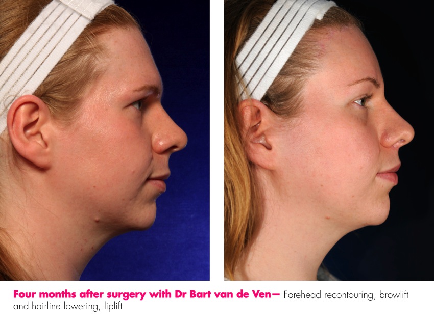 Facial feminization surgery before after full size