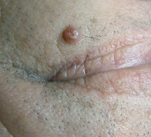 Different types of moles on skin 960X872 jpeg