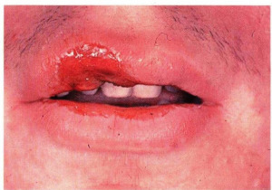 Syphilis sore on lip 640X448 jpeg