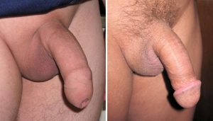 Circumcised vs uncircumcised penis 960X548 jpeg