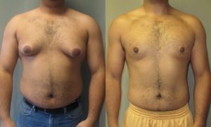 Risperdal side effects breasts 960X576 jpeg