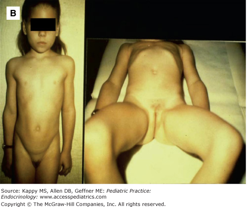 Precocious puberty female old girl full size